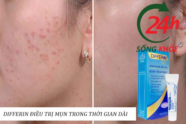 Tác dụng của Differin