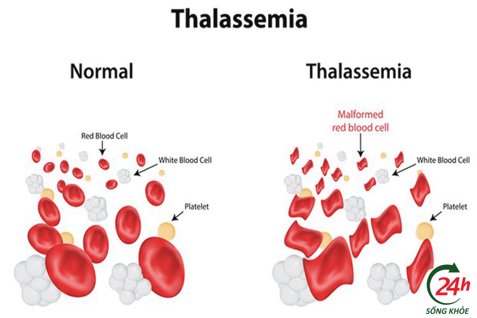Thalassemia là bệnh lý thiếu máu do tan máu