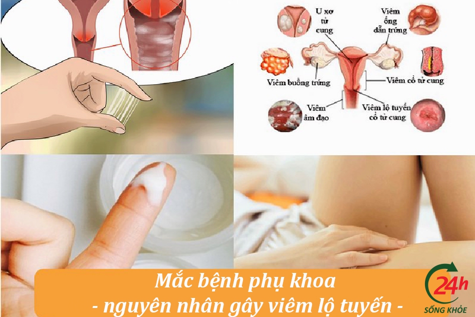 Nguyên nhân viêm lộ tuyến