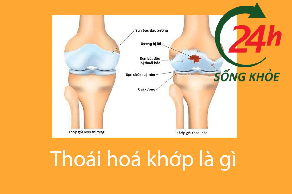 Thoái hoá khớp là gì?