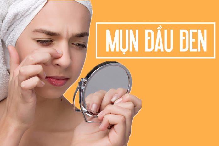 Mụn đầu đen