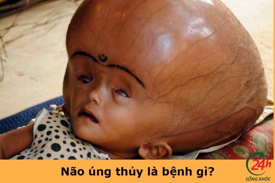 Não úng thủy là bệnh gì?