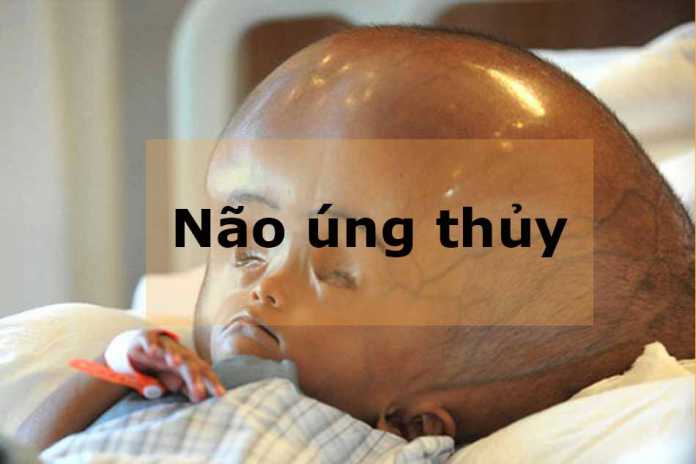 Bệnh não úng thuỷ