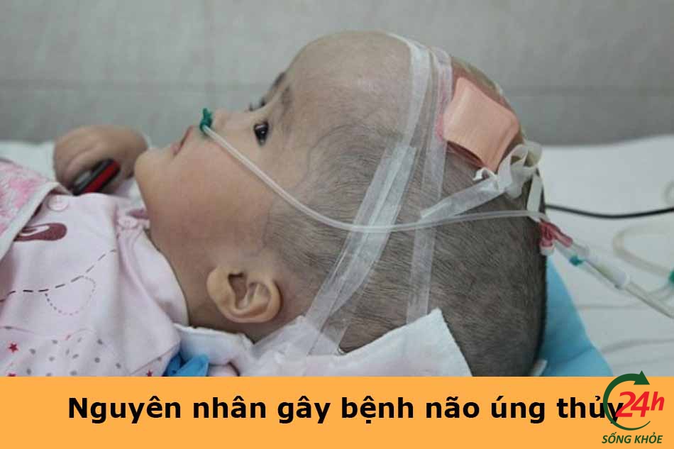 Nguyên nhân gây bệnh não úng thủy