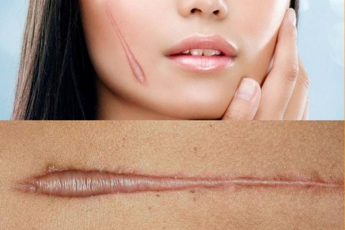 Sẹo lồi