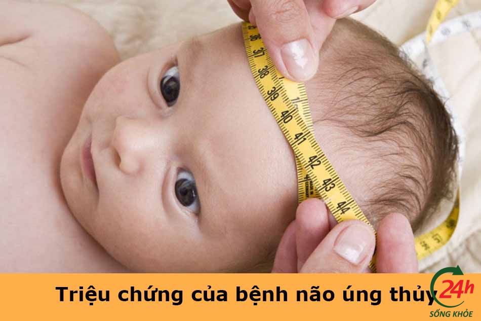 Triệu chứng của bệnh não úng thủy