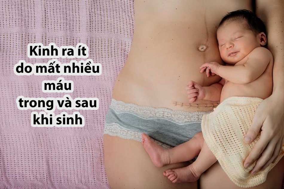 Kinh ra ít do mất nhiều máu trong và sau khi sinh