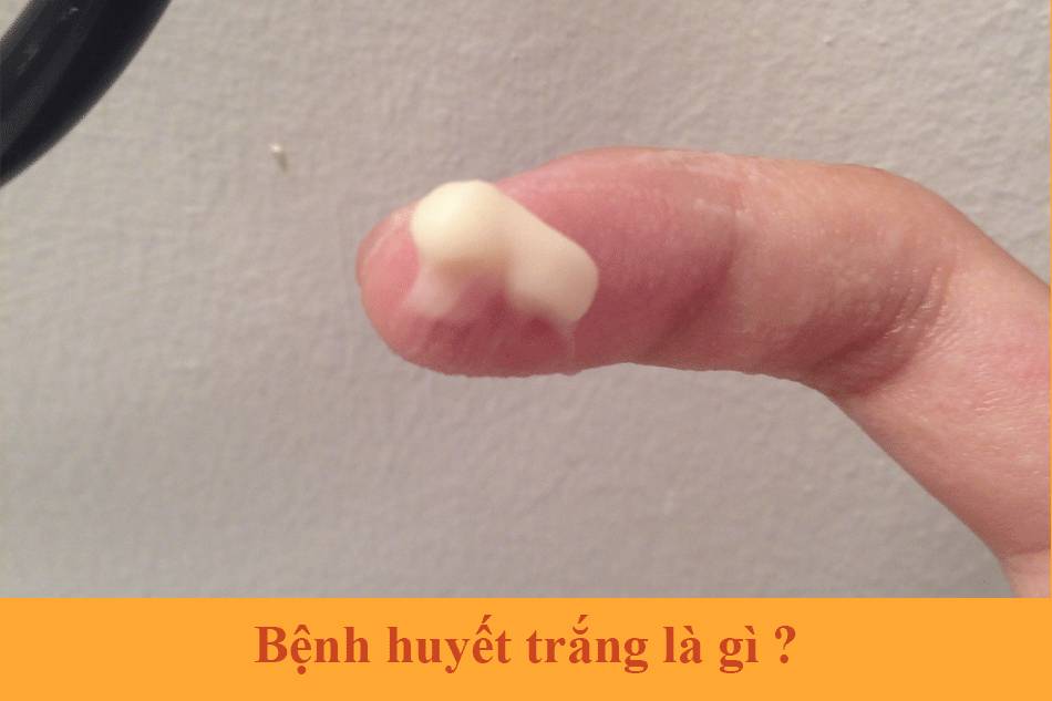 Huyết trắng là gì?