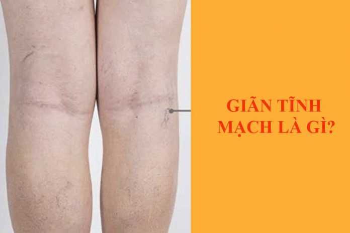 Giãn tĩnh mạch