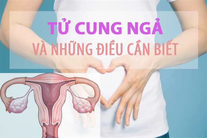 Tử cung ngả
