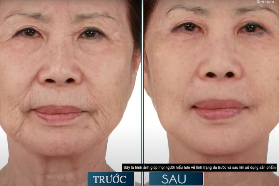 Cải  thiện da rõ rệt sau khi dùng Premium Wrinkle Power Lifting Mask